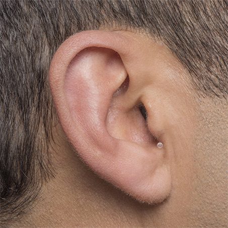 Invisible-In-the-Canal (IIC) hearing aid